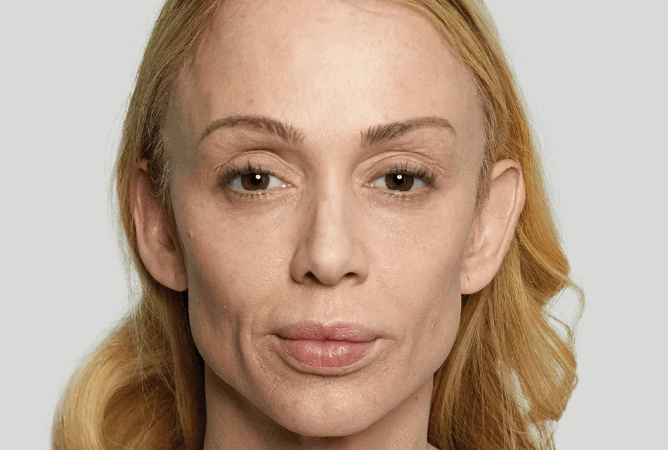 Anna, age 43, prior to Sculptra treatment