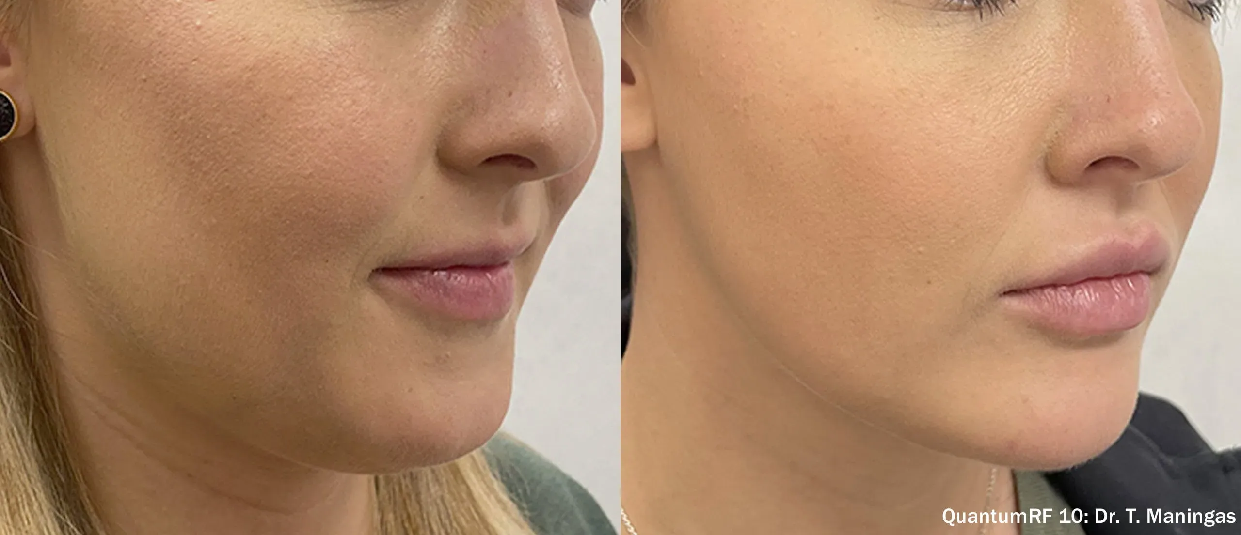 QuantumRF cheek and jawline before and after