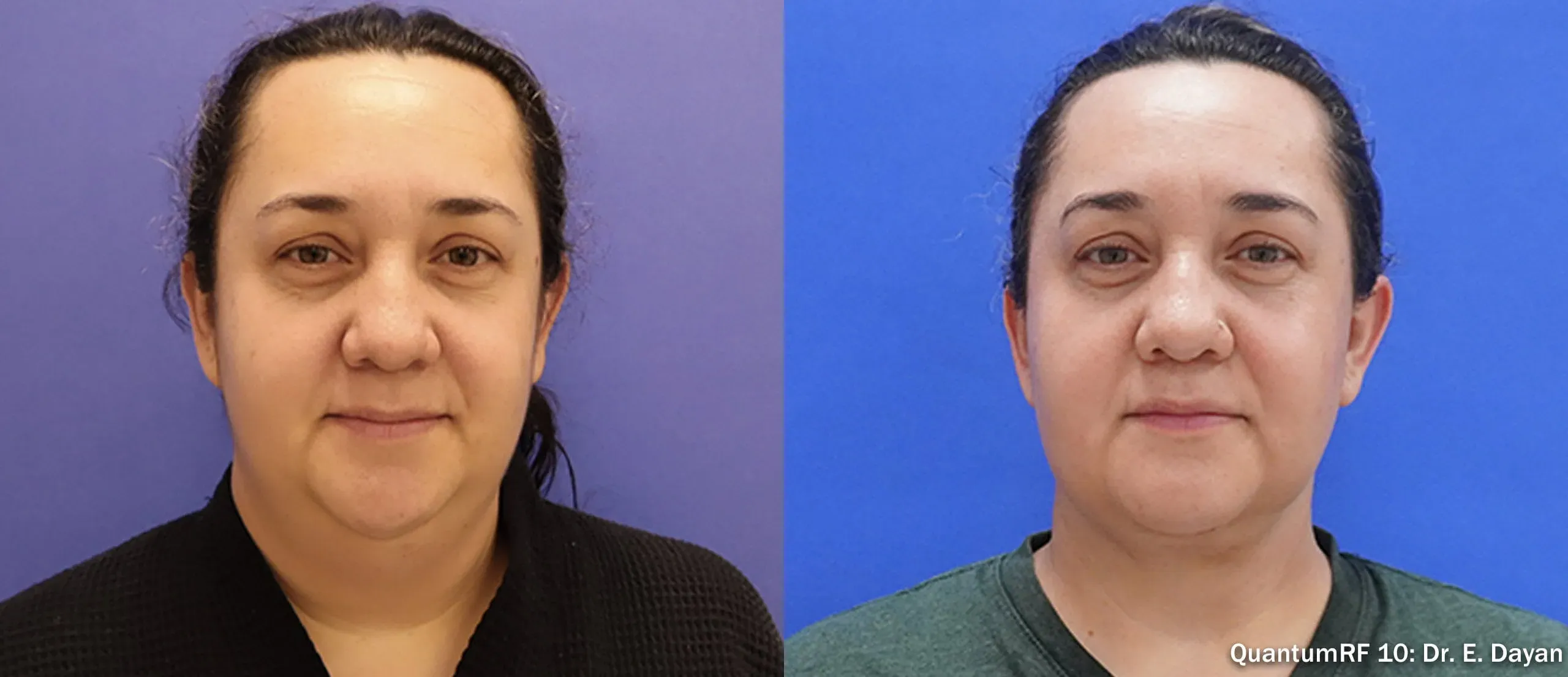QuantumRF full face before and after