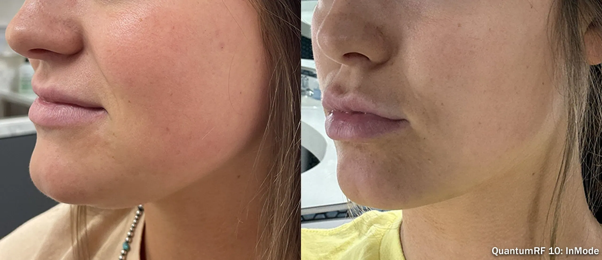 QuantumRF lower face and jawline before and after