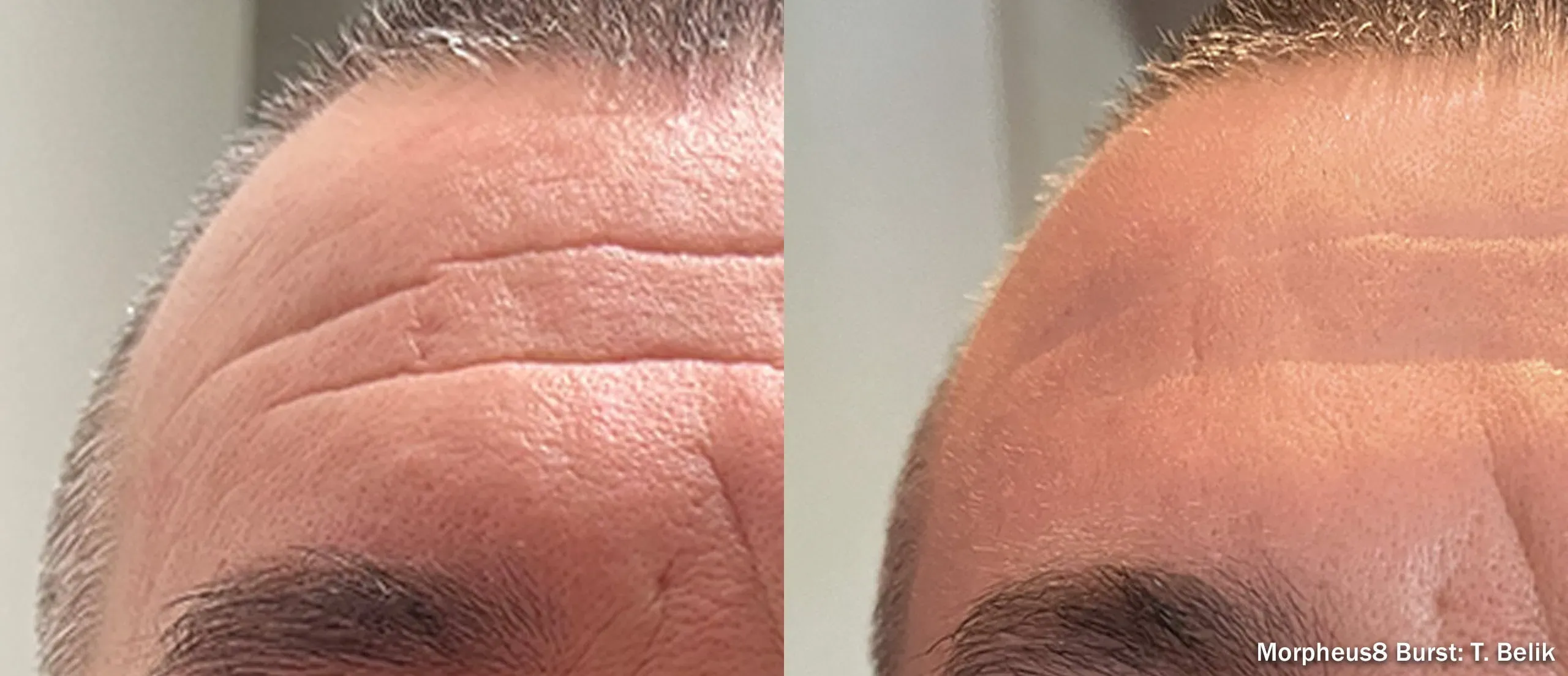 Morpheus8 RF microneedling result