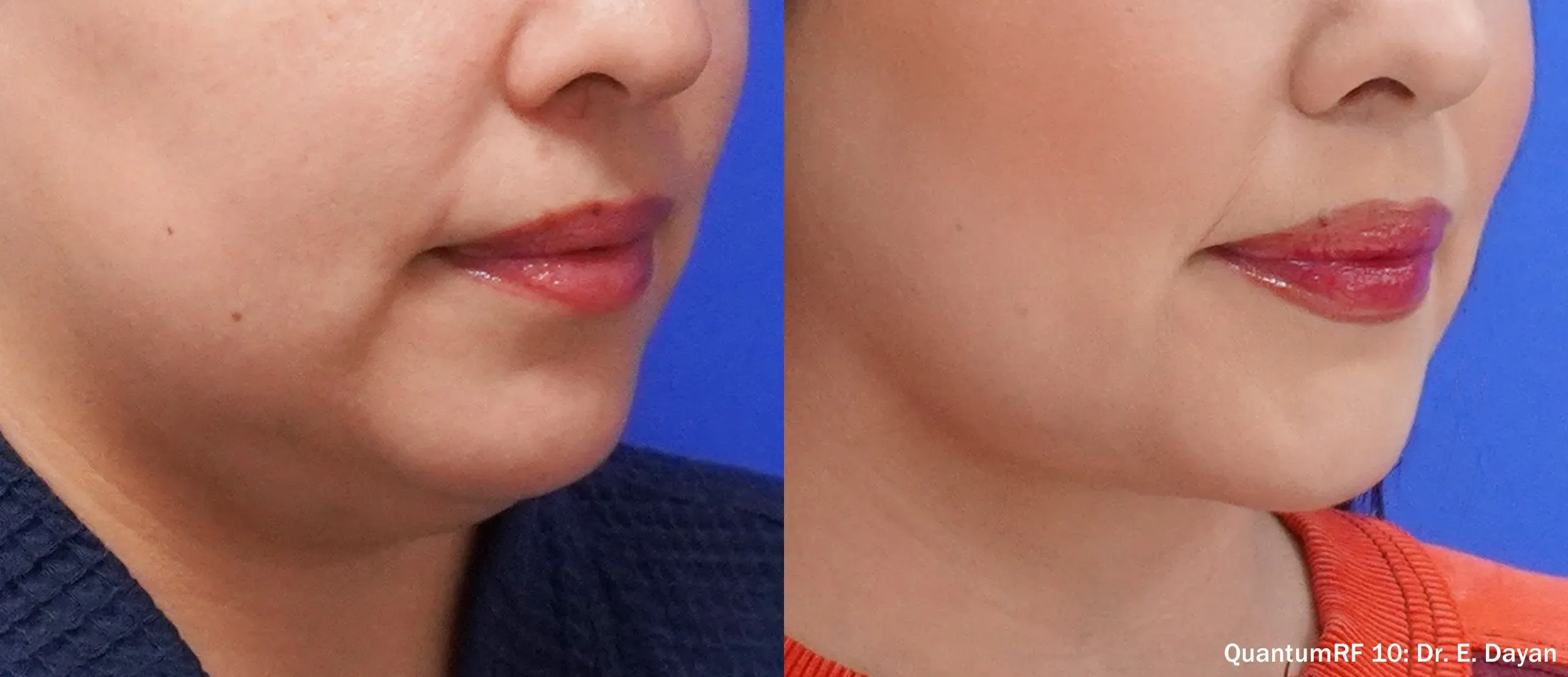 QuantumRF lower face and chin before and after