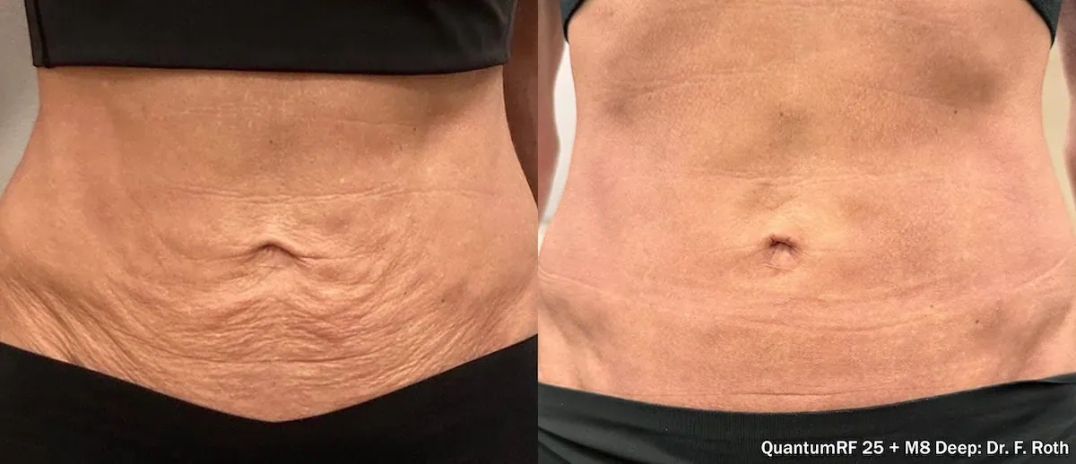 Morpheus8 RF microneedling result at Aetheria Aesthetics & Wellness