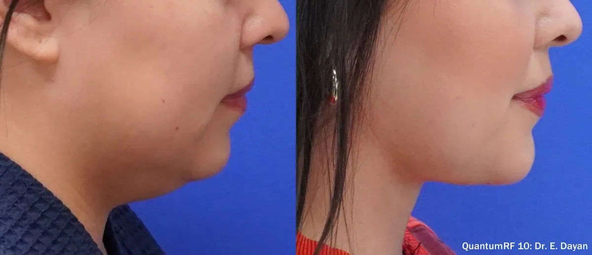 QuantumRF internal RF contouring result at Aetheria Aesthetics & Wellness