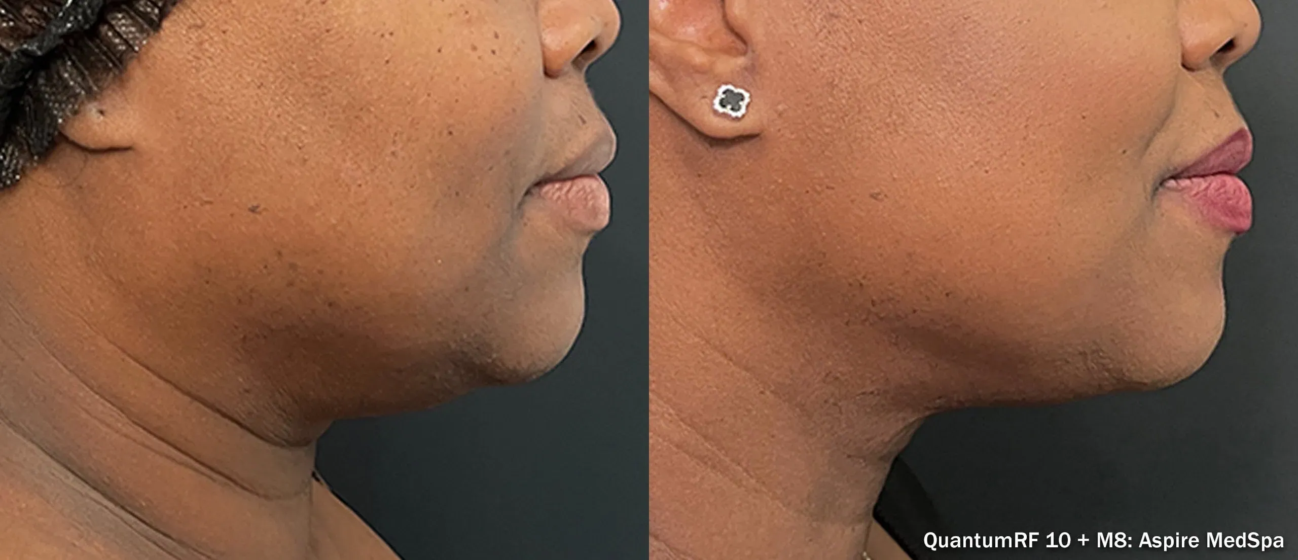 QuantumRF with Morpheus8 neck and jawline before and after
