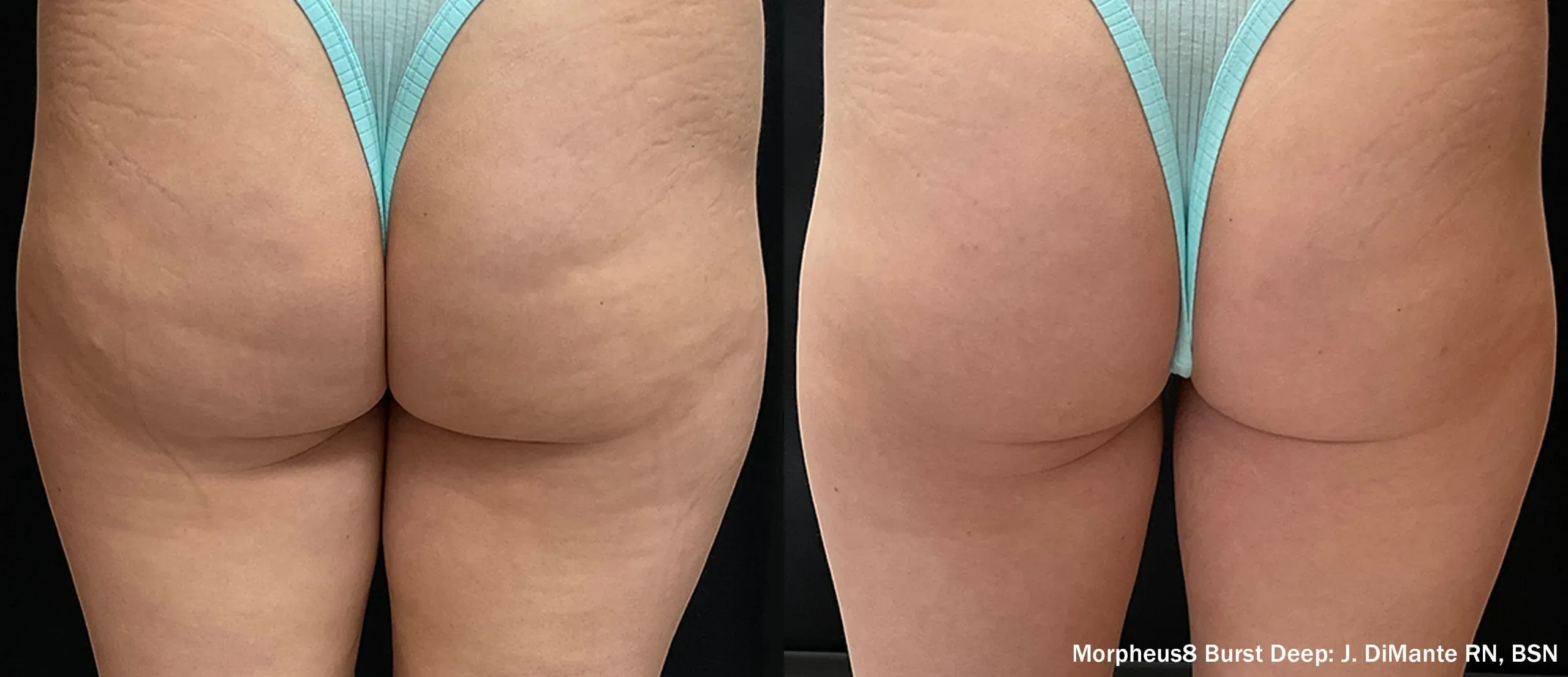 Morpheus8 Burst Deep thighs before and after