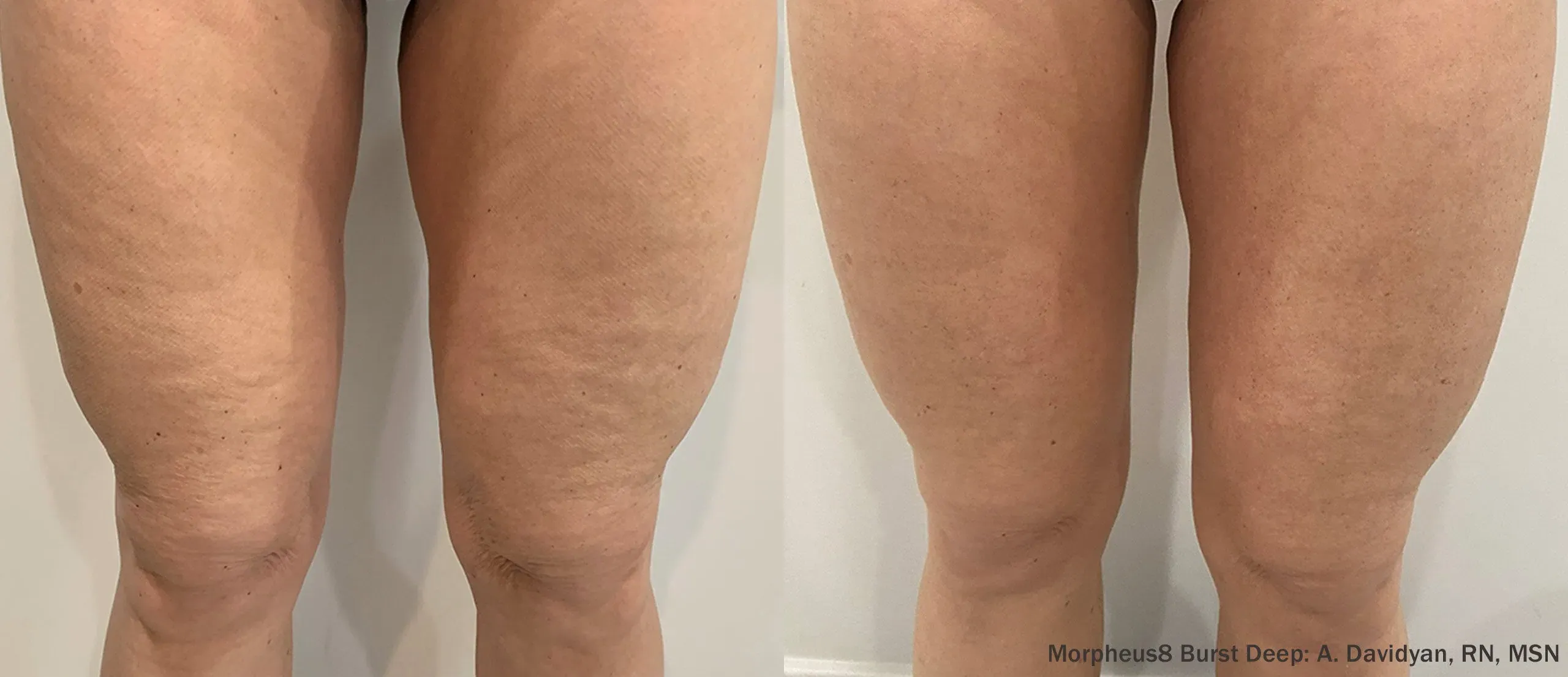 Morpheus8 Burst Deep legs before and after