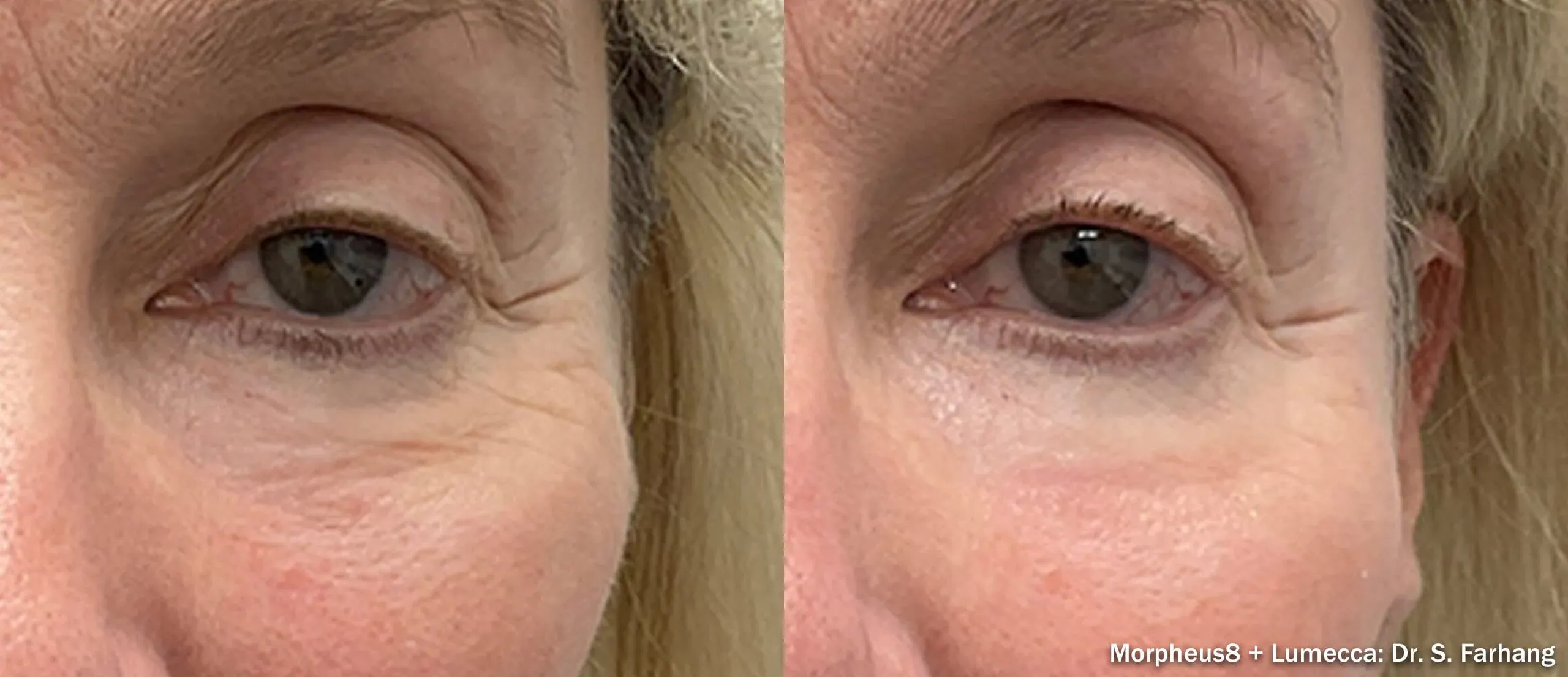 Morpheus8 periorbital before and after