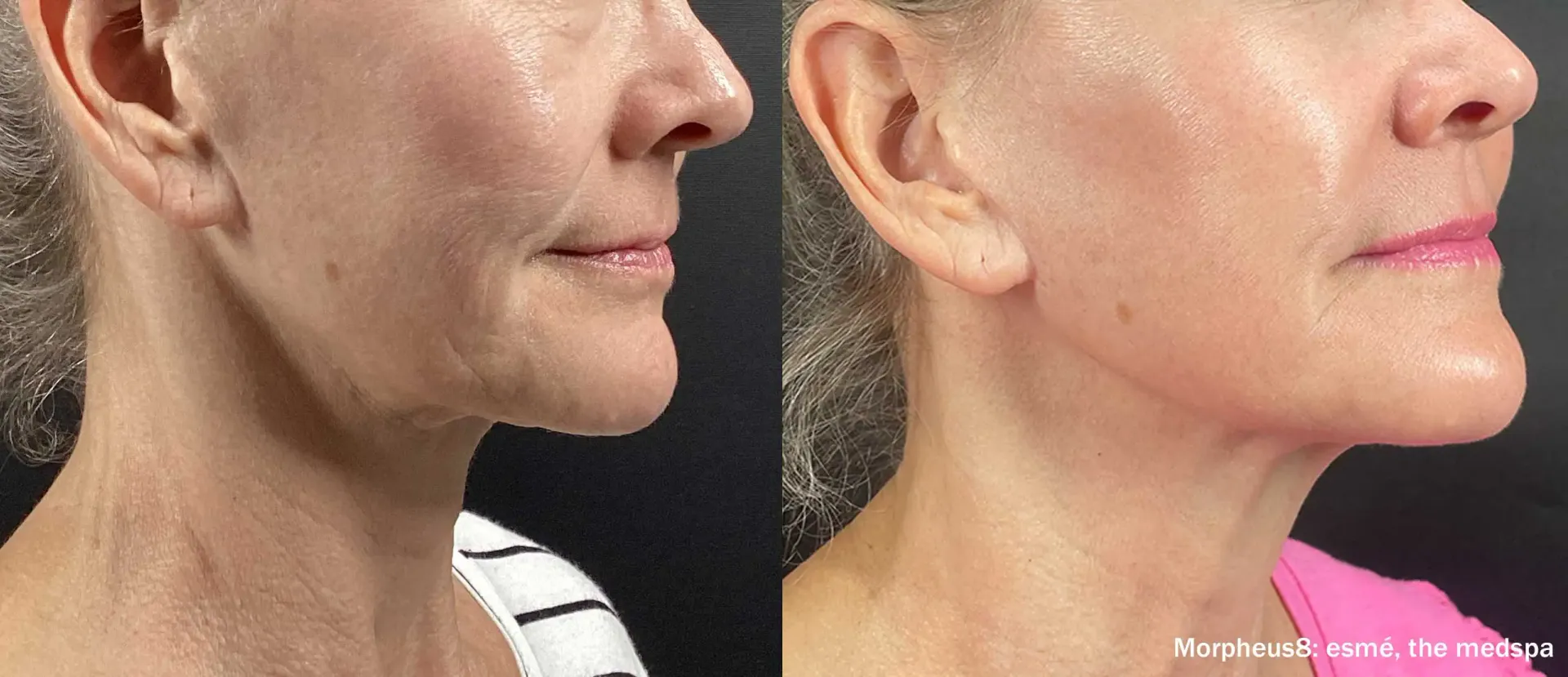 Morpheus8 RF microneedling at Aetheria Aesthetics & Wellness