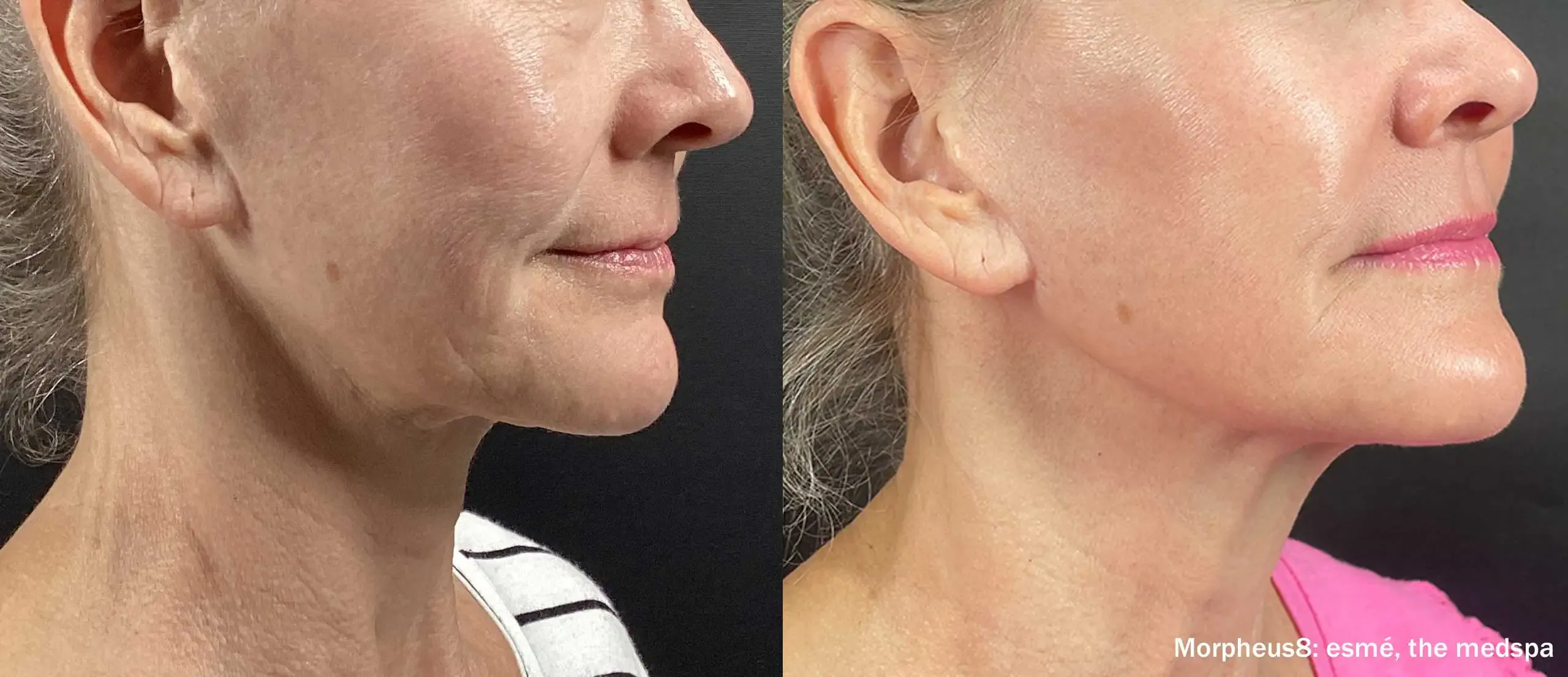 Morpheus8 jawline and jowl before and after