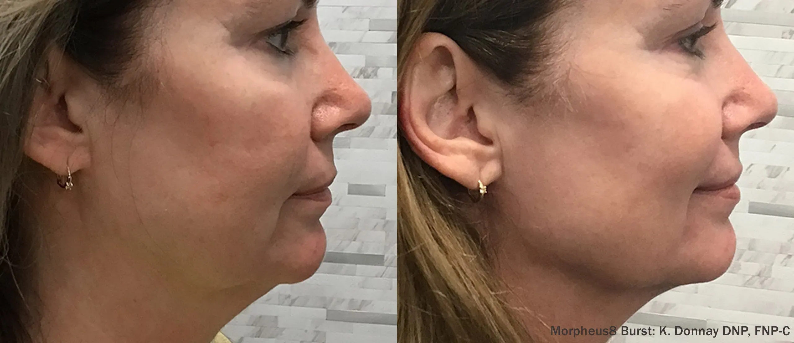 Morpheus8 Resurfacing central face before and after