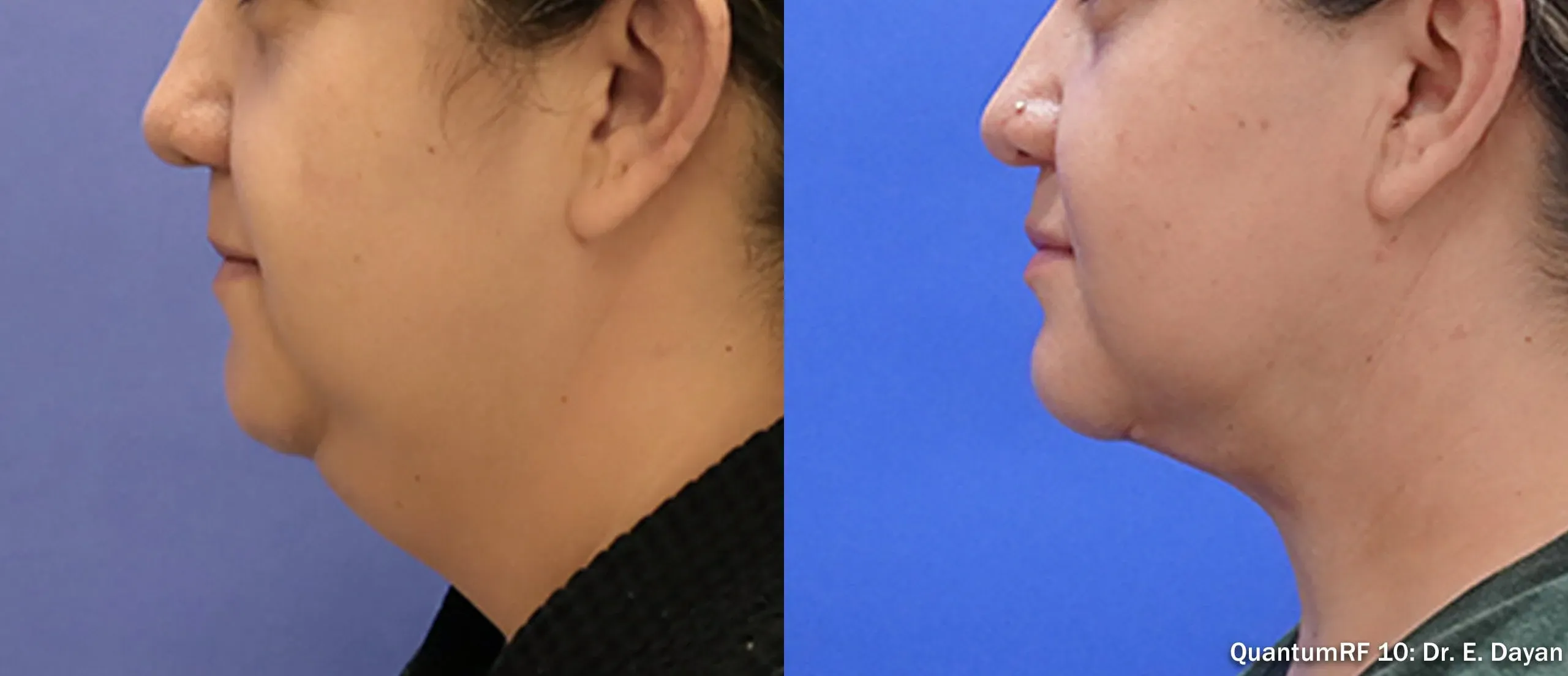 QuantumRF submental before and after